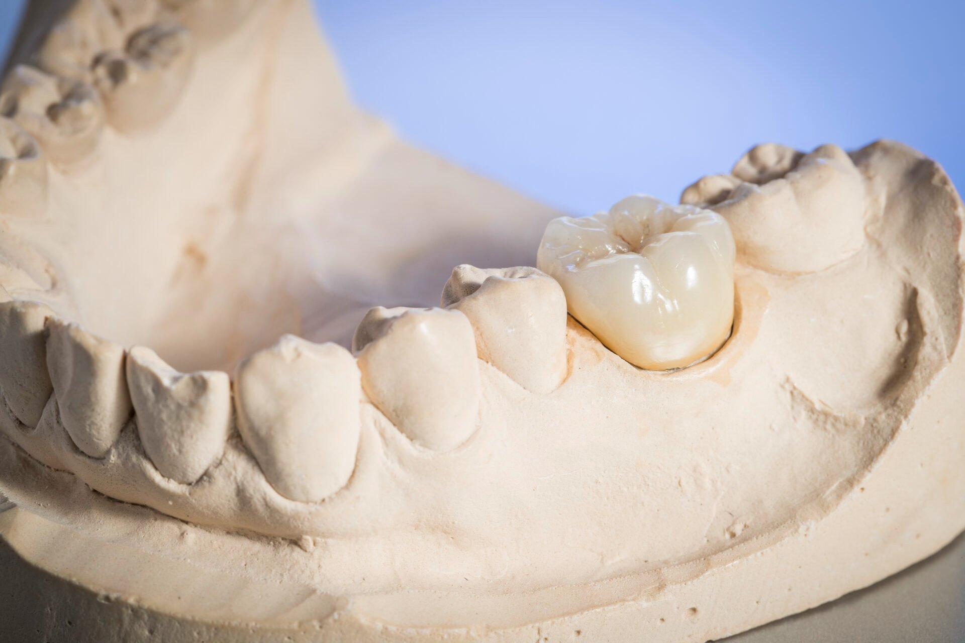 Akikcadcamprosthetics